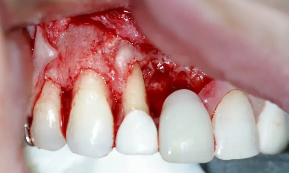 Clinical photo from Hope's smile reconstruction case